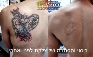 כיסוי צלקת עגולה בגב